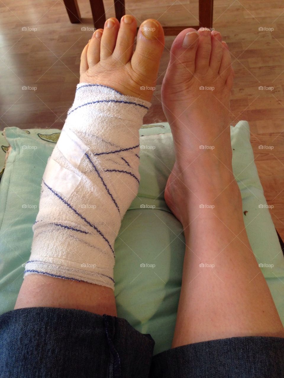 Foot in bandage