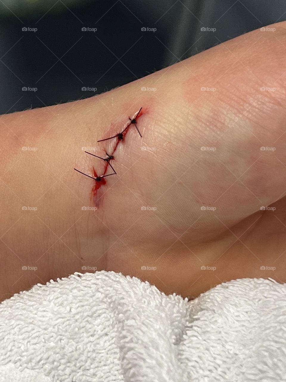 Stitches 