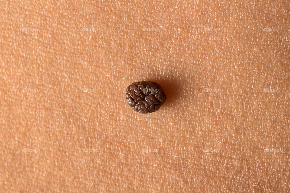 macro of mole on the skin