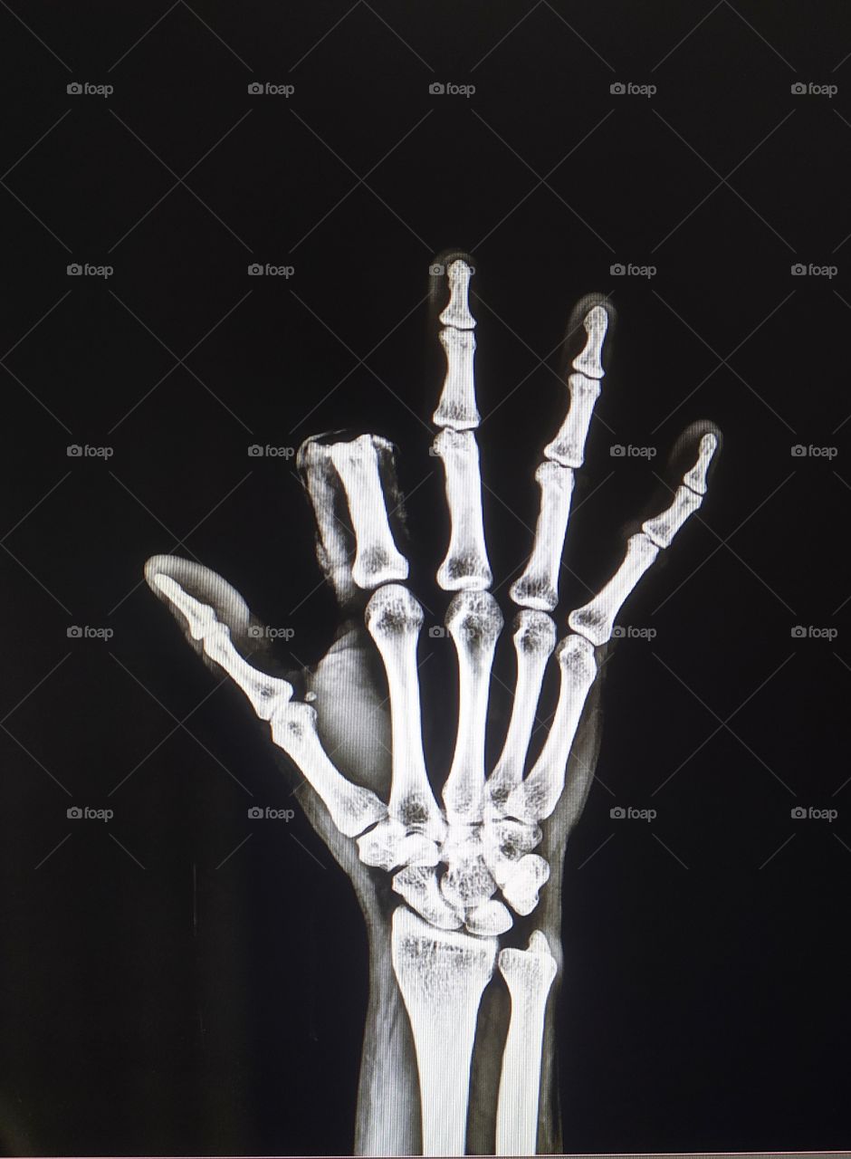 xray view of Hand Ap shows injury of index  finger