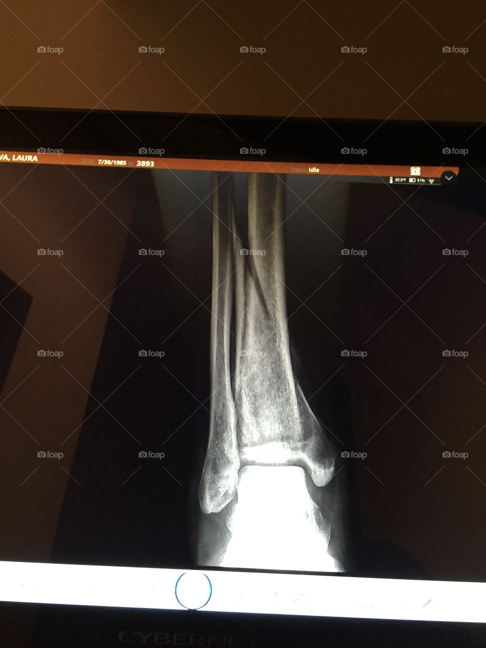 X-ray. Pilon spiral fracture 