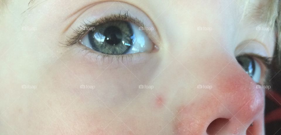 Down Syndrome, beautiful eye