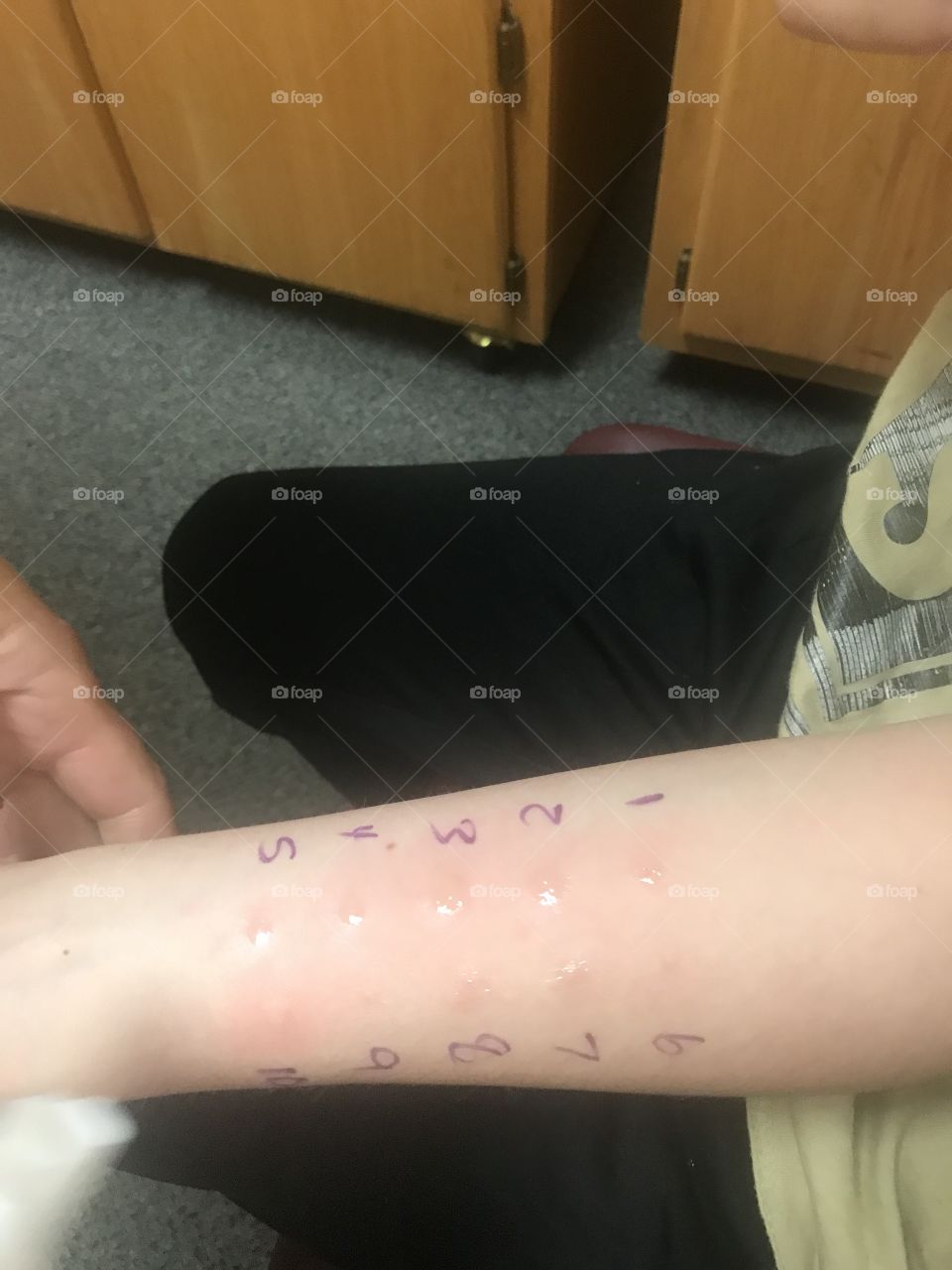 Allergy tests
