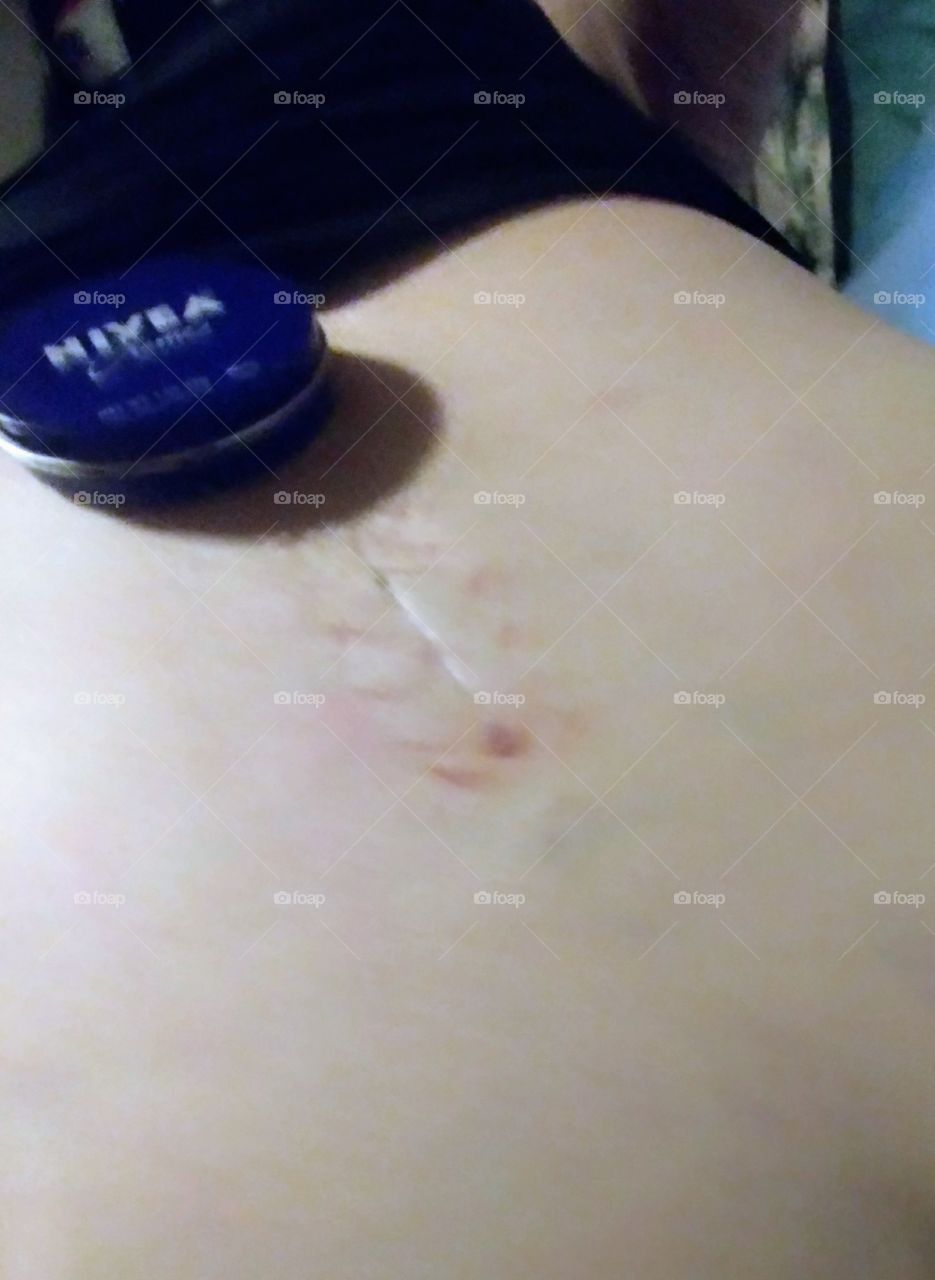 Niveau cream has helped me with post surgery recovery