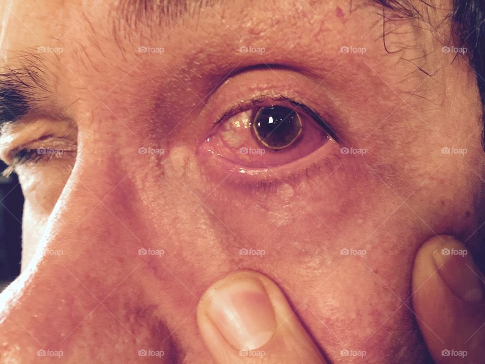 Corneal Eye Disease
