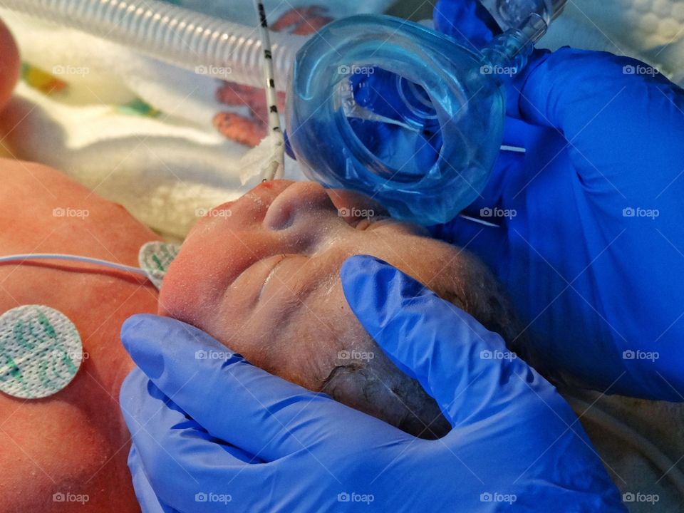 Newborn Premature Infant In Intensive Care
