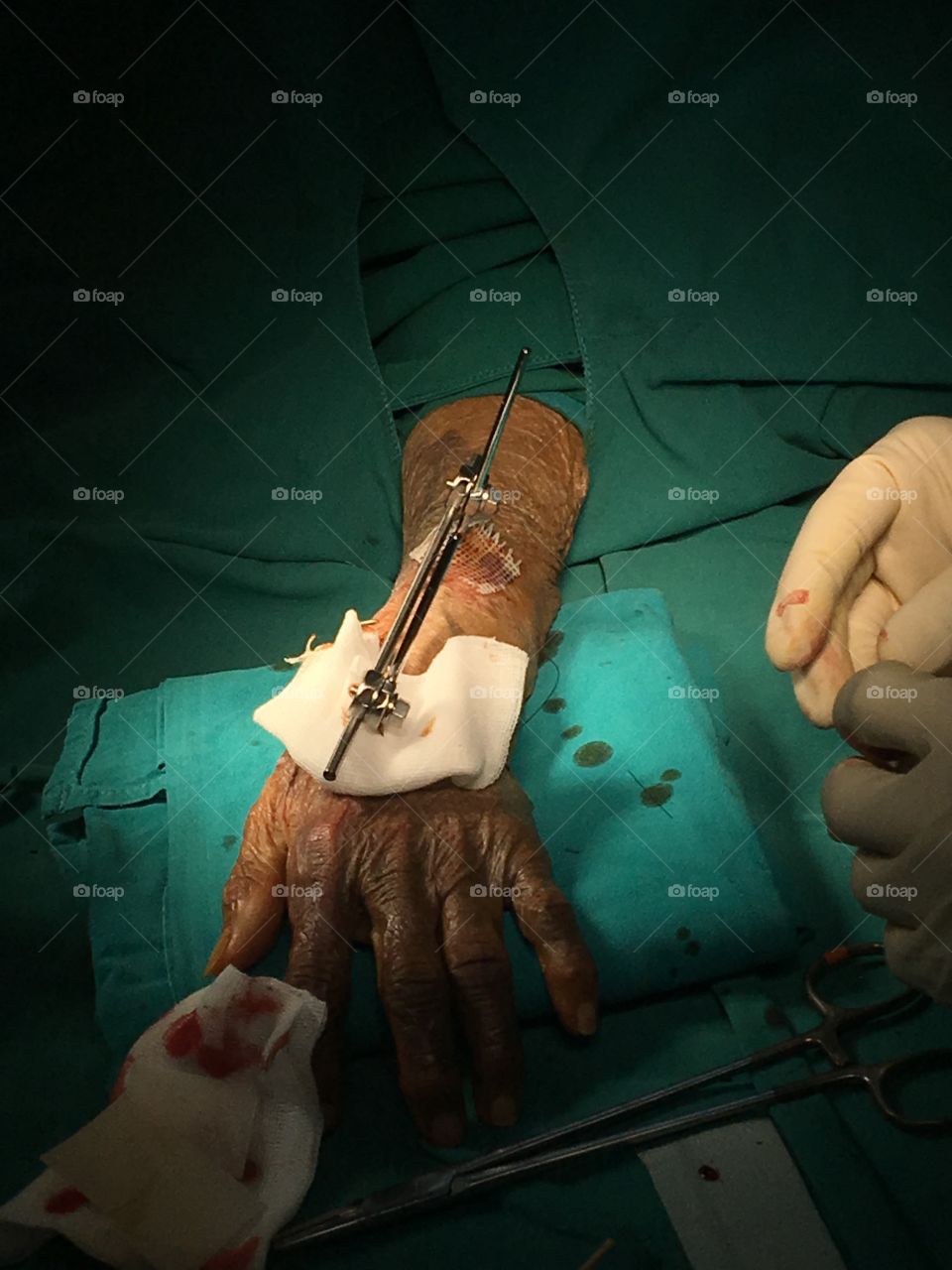 Person's burnt hand in operation theater
