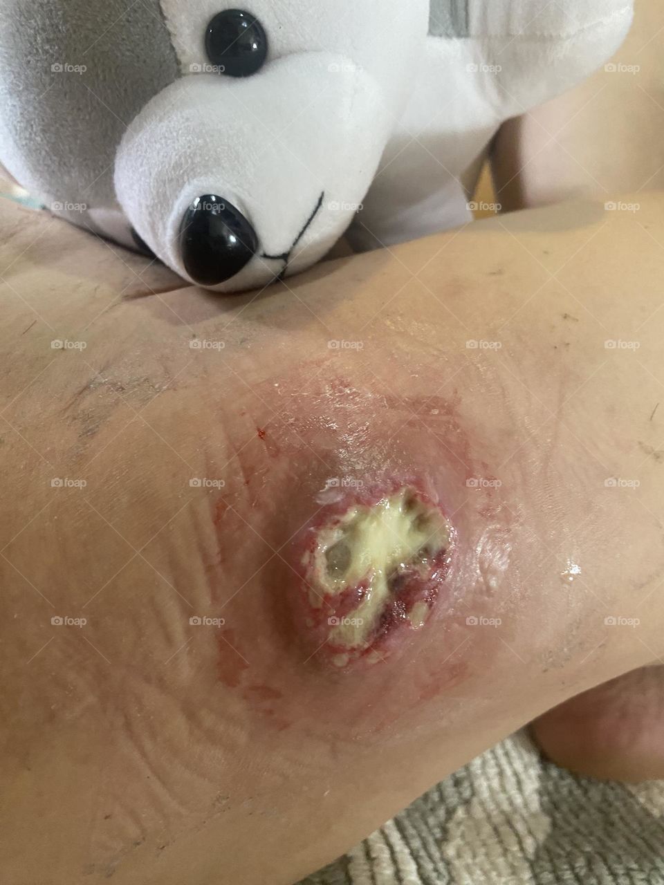 I got a very painful abscess in my leg 