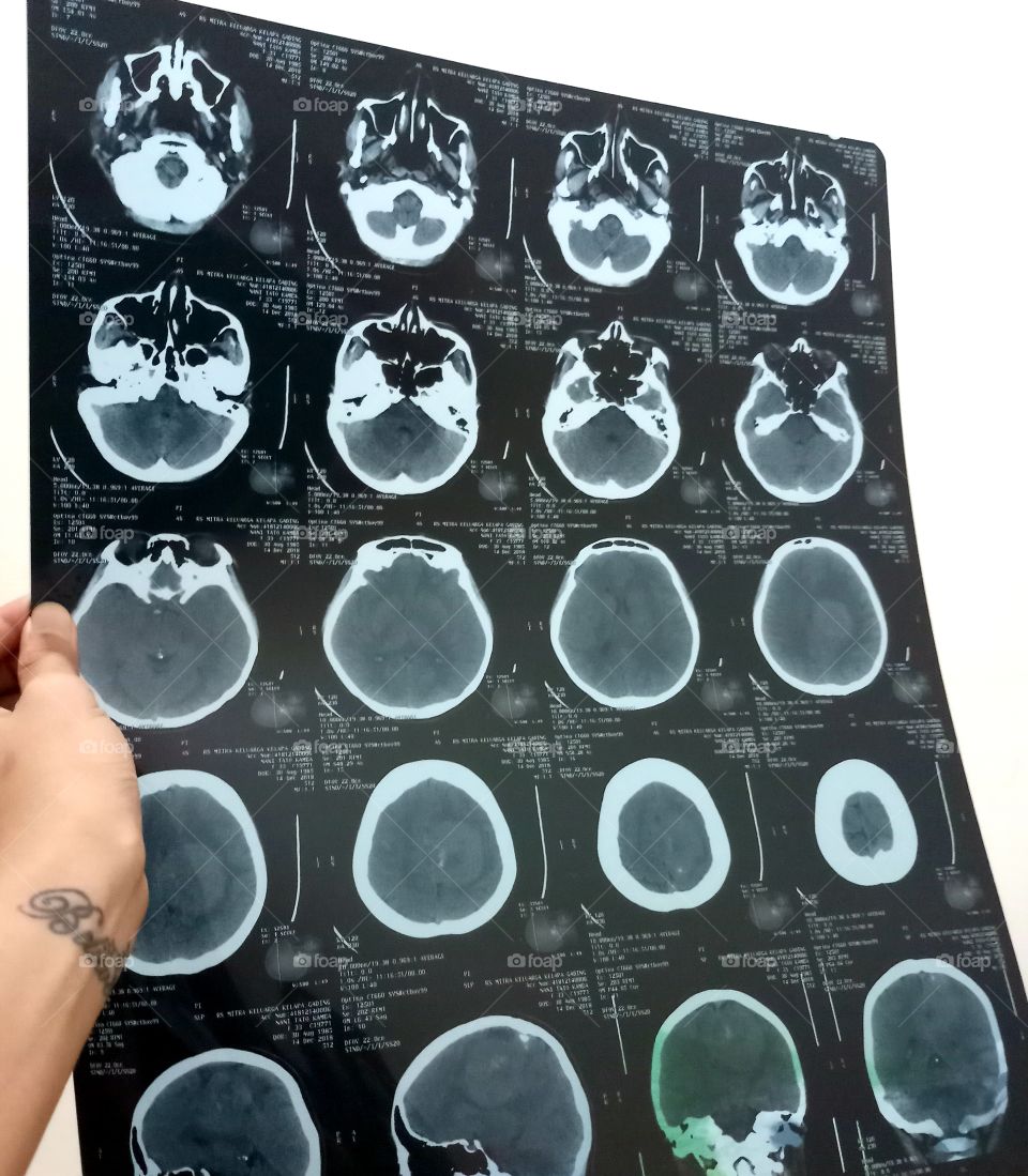 Brain Meningioma CT Image.