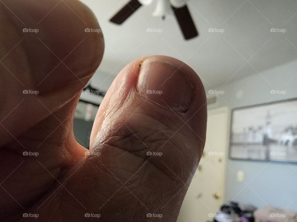 poor toe