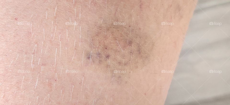 a hematoma on the leg
