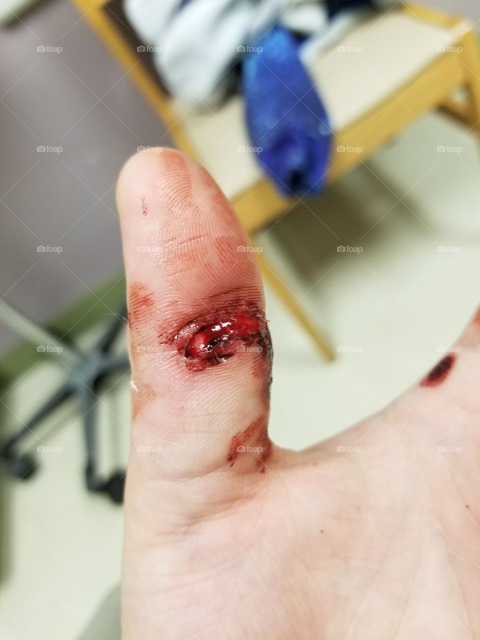 my broken thumb