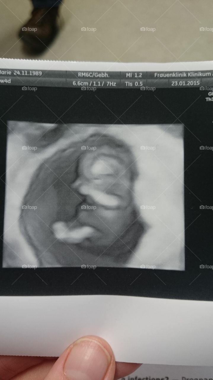 ultrasound pic . my pregnancy at 10 weeks 
