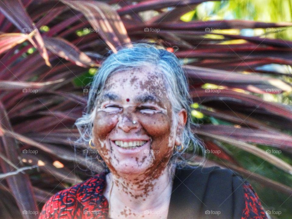 Vitiligo Skin Condition