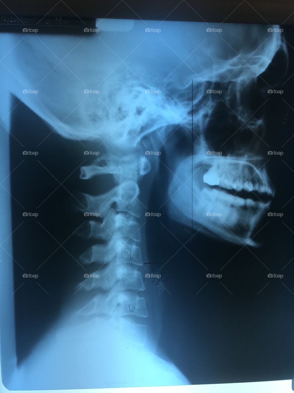 Straight cervical spine, indicative of whiplash 