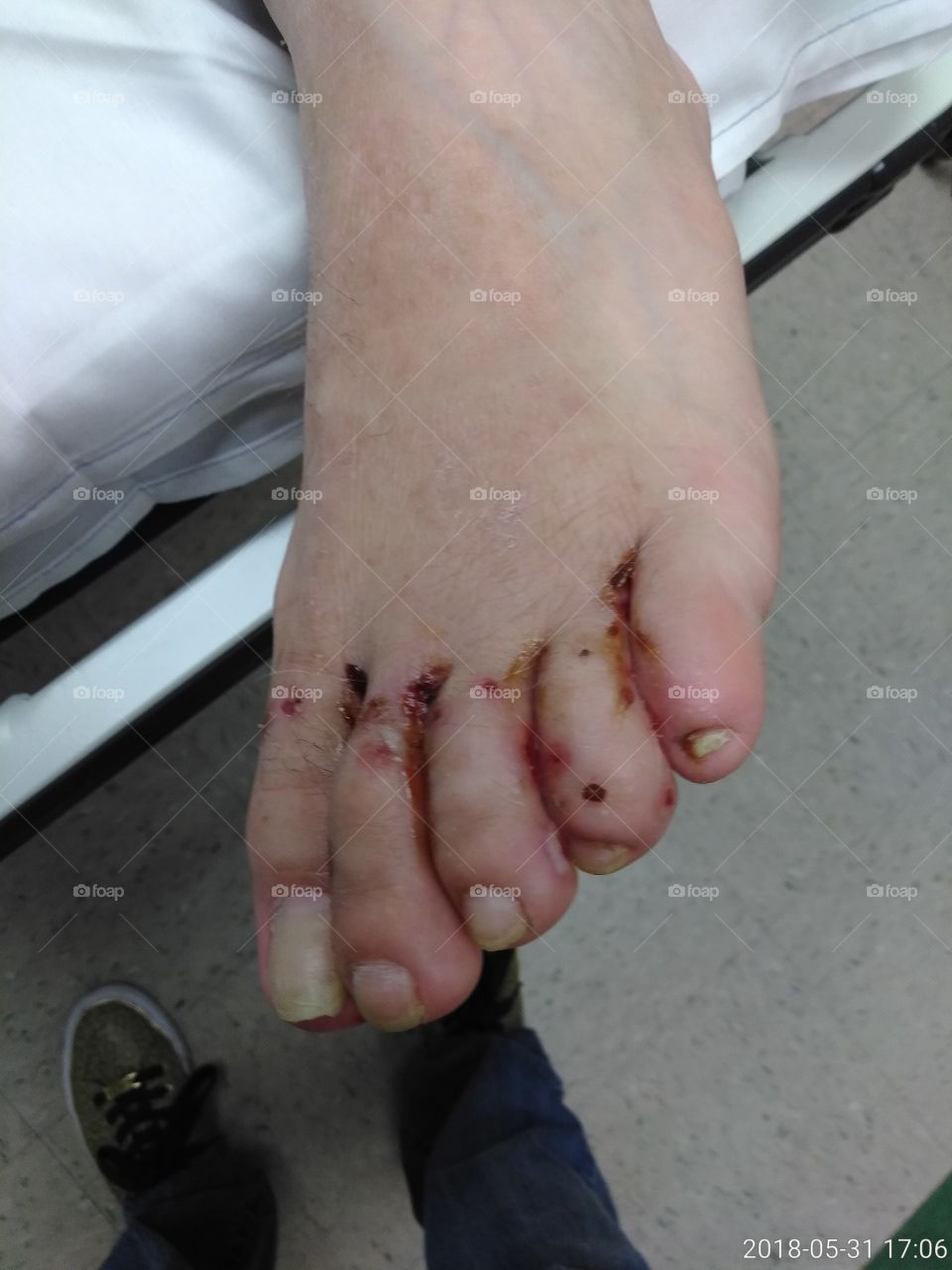 severe infection in toes