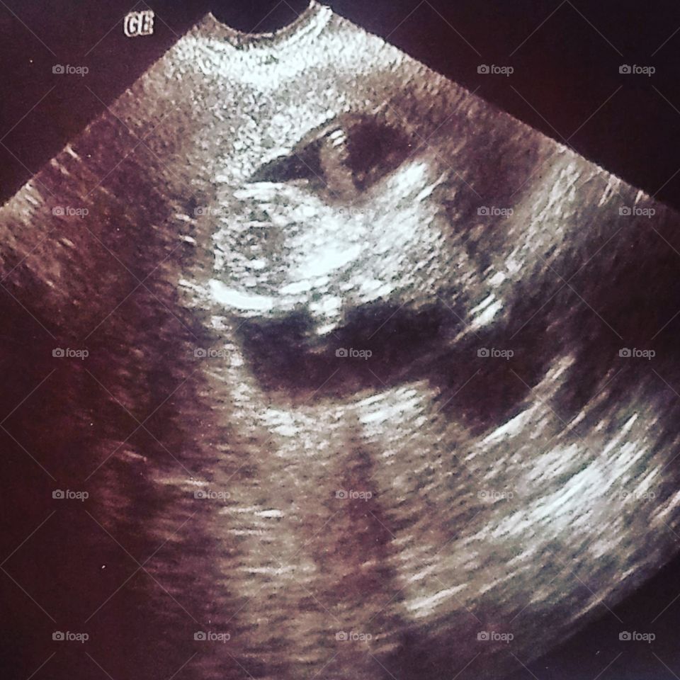 Ultrasound picture of my new baby.