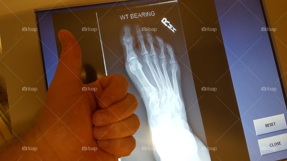 no HIPAA violations here, just a good foot xray