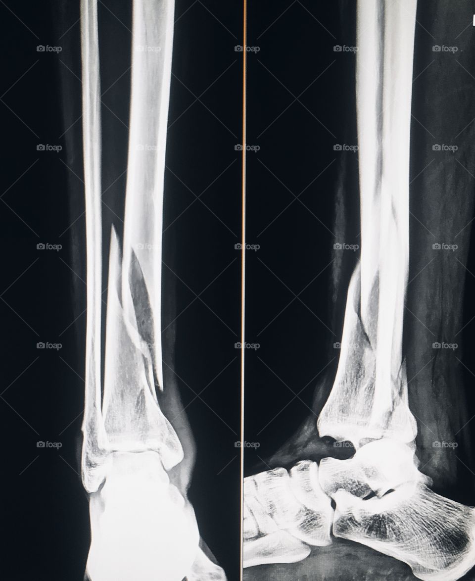 Xray shows Tibia Fracture in road Accident