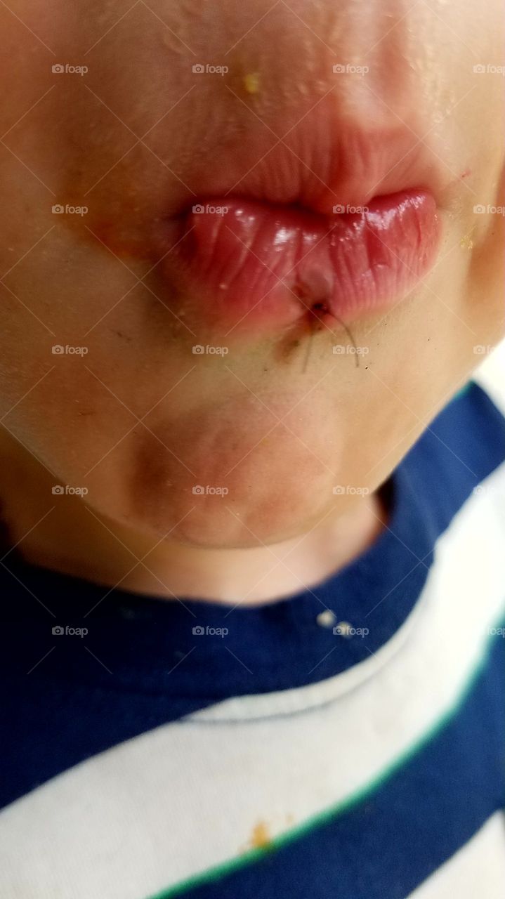 Gradyn busted his lip and has a stitch