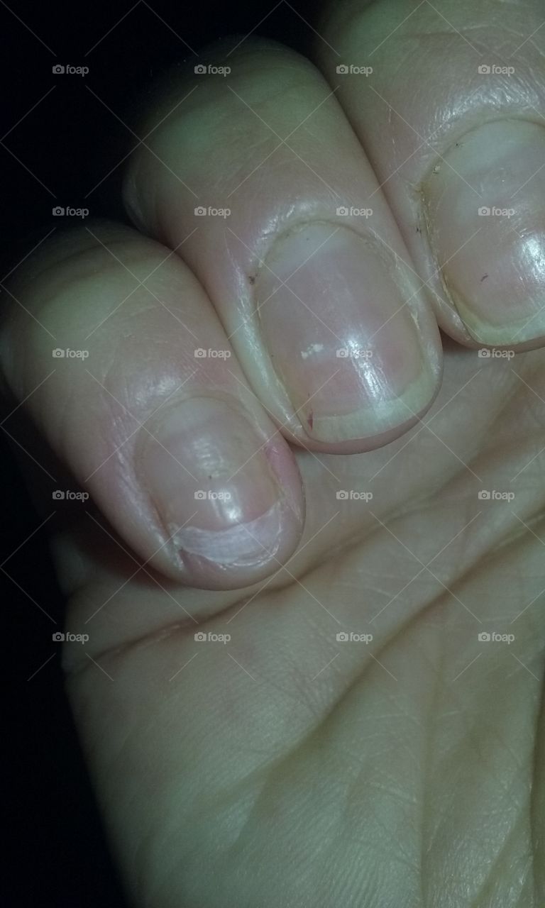 Broken nails