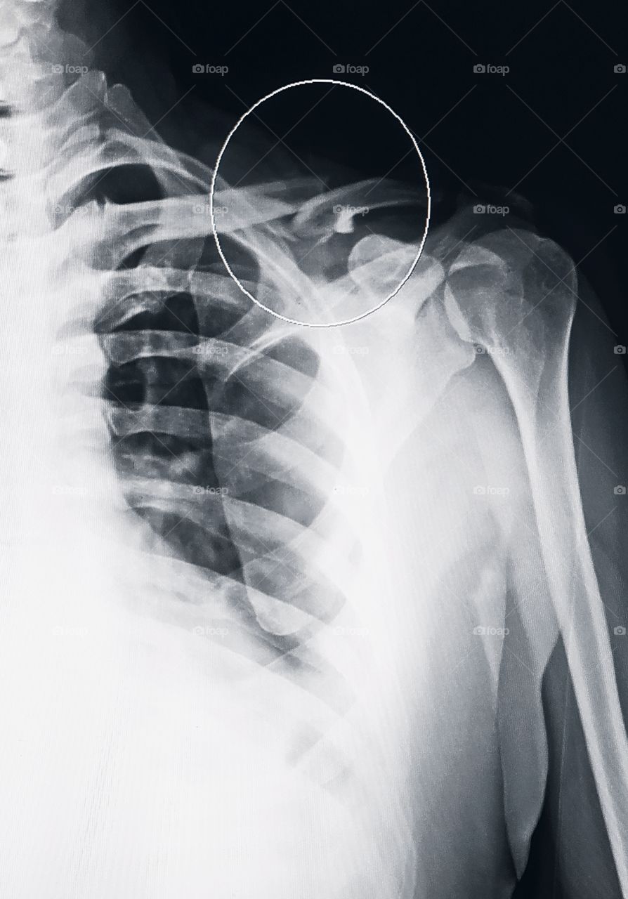 Xray of Shoulder Ap View shows Fracture