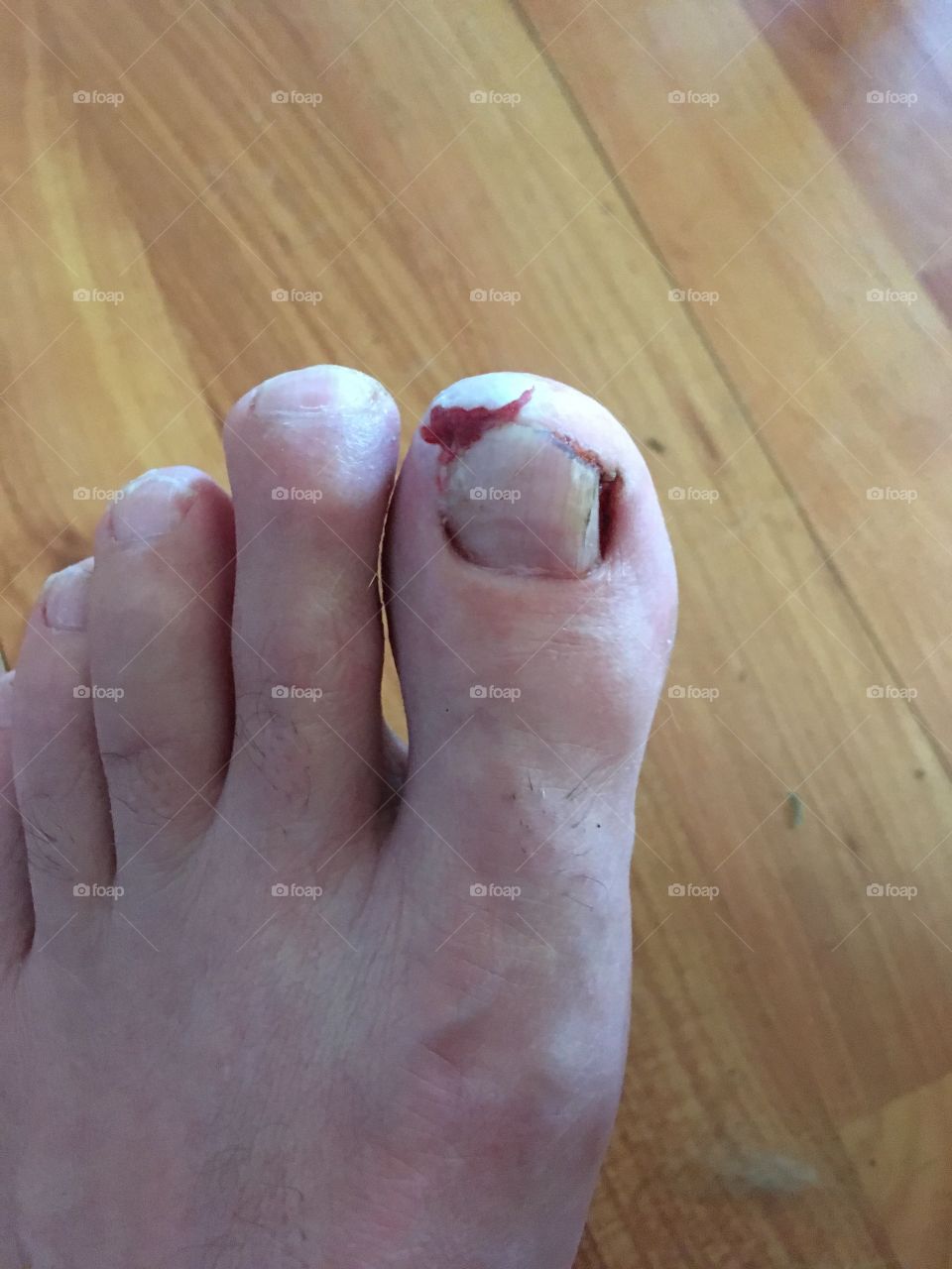 Can of soup dropped on my husbands toe!This is what it looks like now after the  bleeding.