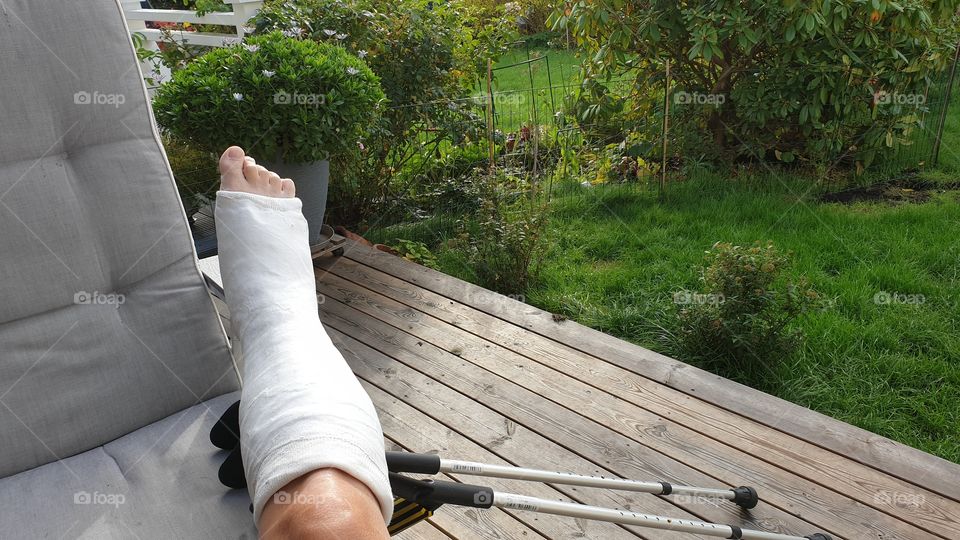 Short leg cast  foot surgery - gips underben fotoperation 