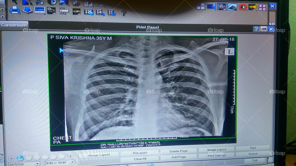 chest xray