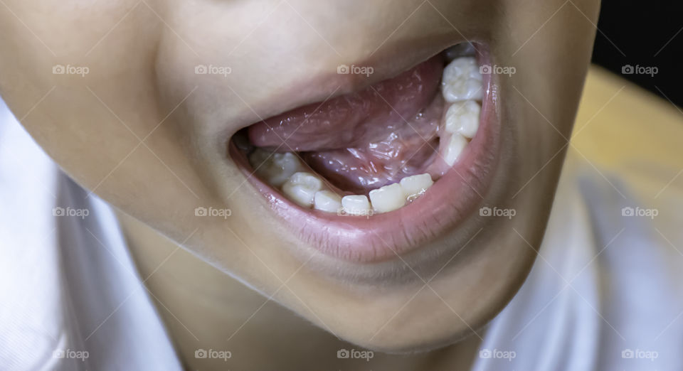 Baby teeth are just dropped in the mouth.