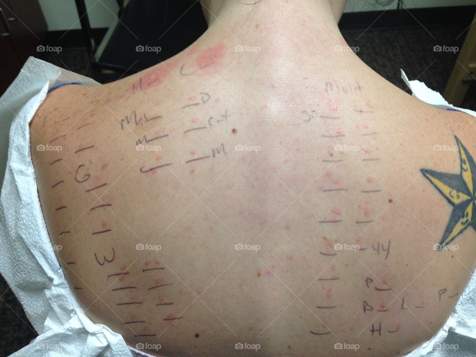Allergy Testing