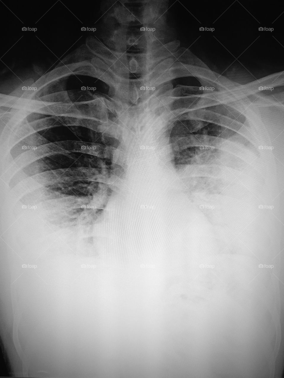 Xray of Chest shows Bad prognosis in covid19 disease