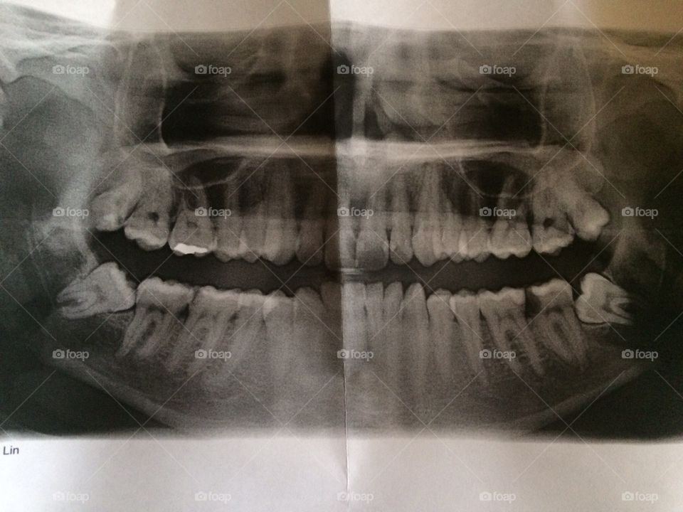 X-ray. Dental. Impacted. Cavity. Filling. Drill. Oral. Surgery. Mouth. Tooth. Pain. Jaw. Toothache. 